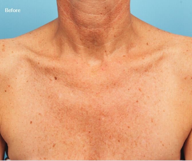 Lumenis Stellar M22- IPL Laser Machine 2 1