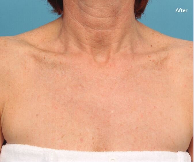 Lumenis Stellar M22- IPL Laser Machine 3 2