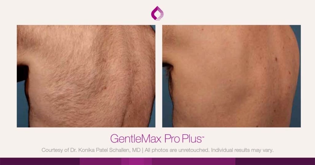 Candela Gentlemax Pro PLus Laser Hair Removal Machine 2 Back B A