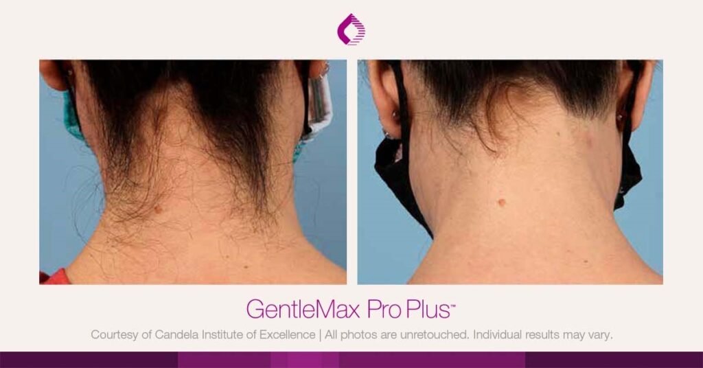 Candela Gentlemax Pro PLus Laser Hair Removal Machine 3 Back of neck B A