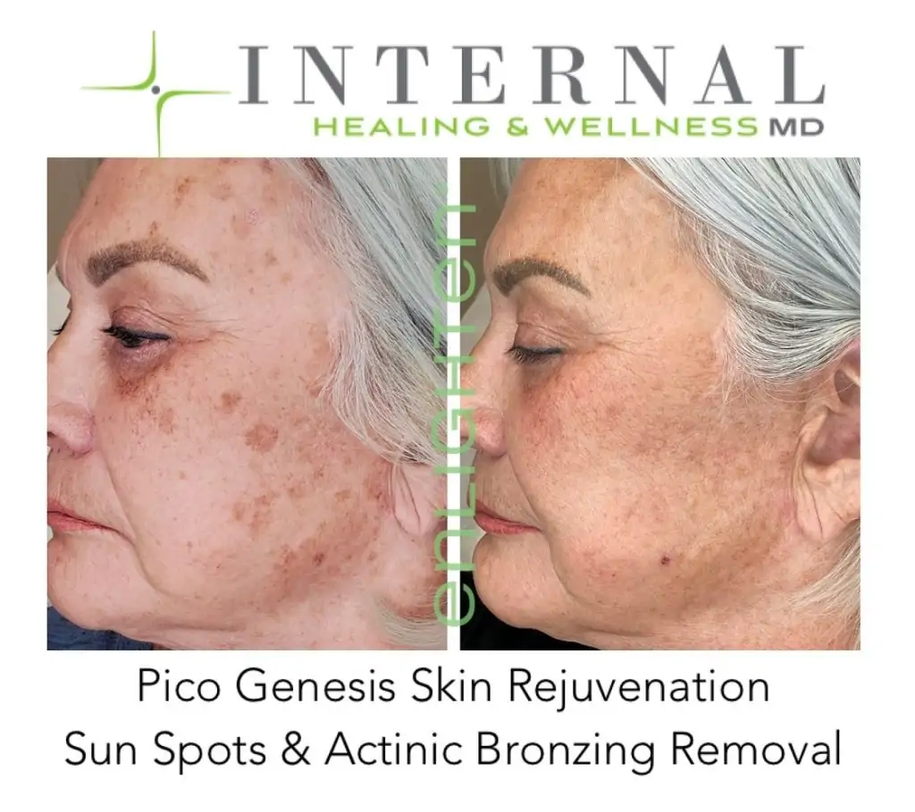 CUTERA Enlighten III Picosecond + Nanosecond Tattoo Removal Laser 3 Cutera-Enlighten-Before-and-after-results