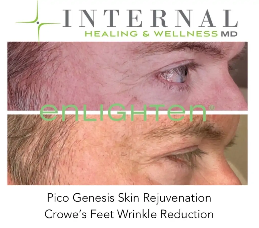 CUTERA Enlighten III Picosecond + Nanosecond Tattoo Removal Laser 4 Cutera Enlighten Before and after results 11