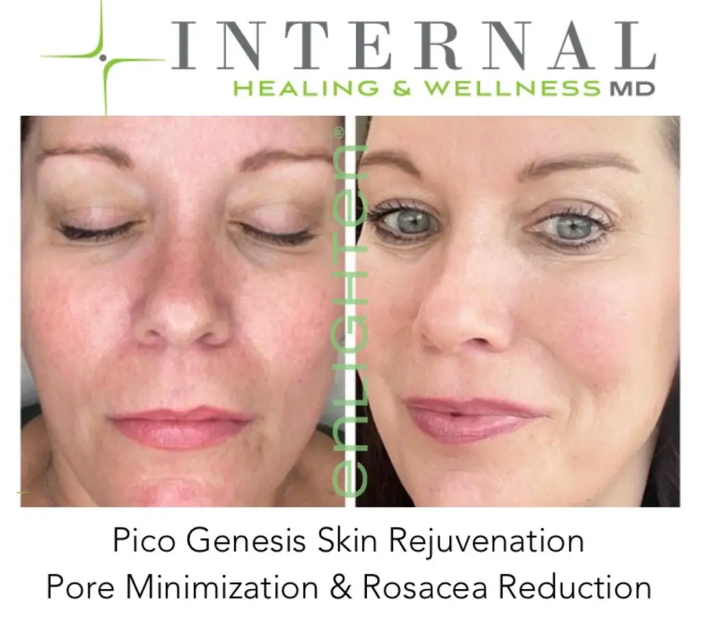 CUTERA Enlighten III Picosecond + Nanosecond Tattoo Removal Laser 5 Cutera Enlighten Before and after results 12