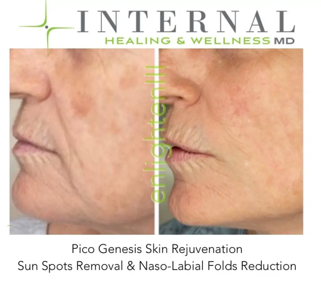 CUTERA Enlighten III Picosecond + Nanosecond Tattoo Removal Laser 6 Cutera Enlighten Before and after results 13