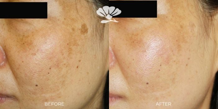 CUTERA Enlighten III Picosecond + Nanosecond Tattoo Removal Laser 7 Enlighten III Pigmentation