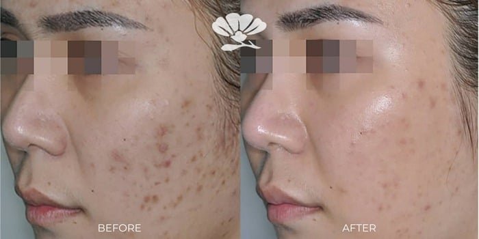 CUTERA Enlighten III Picosecond + Nanosecond Tattoo Removal Laser 9 Enlighten-iii-skin-resurfacing-laser-Pico-Genesis-FX