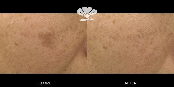 CUTERA Enlighten III Picosecond + Nanosecond Tattoo Removal Laser 8 Enlighten-sun-damage