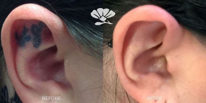 CUTERA Enlighten III Picosecond + Nanosecond Tattoo Removal Laser 10 Enlighten-tattoo-removal-9-months-after-5-treatments