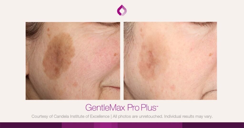 Candela Gentlemax Pro PLus Laser Hair Removal Machine 4 Facebook Linkedin Twitter copy 7