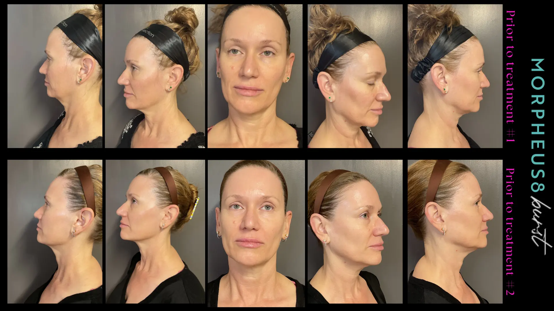 InMode Morpheus8 RF Pro Fractional RF Microneedling Machine 2 Generation Morpheus8 Burst For Face