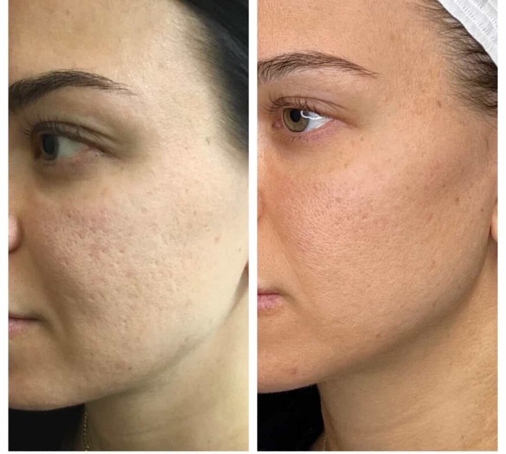 InMode Morpheus8 RF Pro Fractional RF Microneedling Machine 3 IMG 5158 2