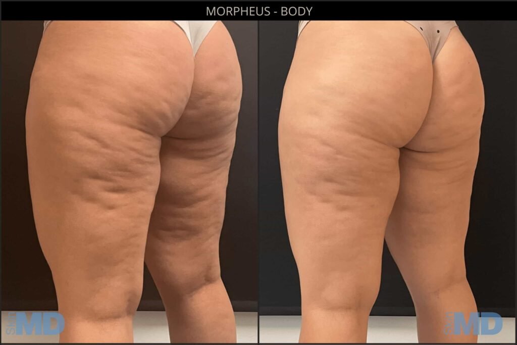 InMode Morpheus8 RF Pro Fractional RF Microneedling Machine 4 Morpheus BODY AUGUST 2022 BA 3 WEB DONE scaled 1