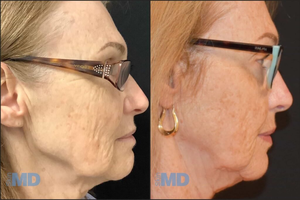 InMode Morpheus8 RF Pro Fractional RF Microneedling Machine 5 Morpheus Skin MD Peabody BA 3 scaled 1