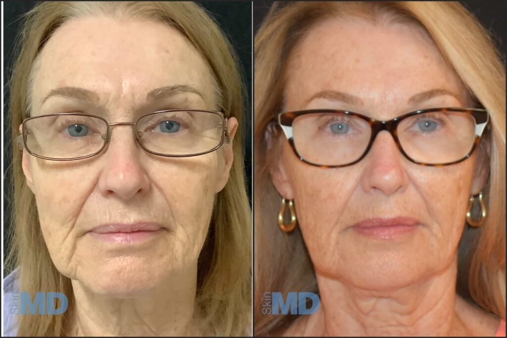 InMode Morpheus8 RF Pro Fractional RF Microneedling Machine 6 Morpheus Skin MD Peabody BA 4 scaled 1