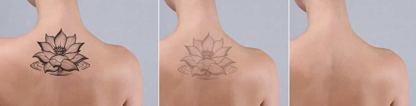 Tattoo removal before and after