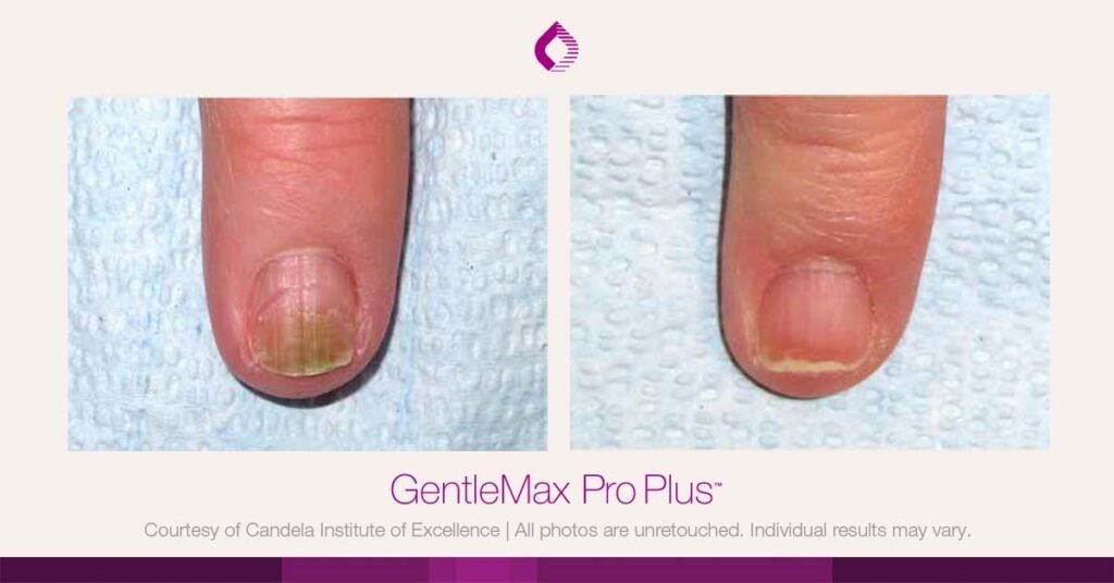 Candela Gentlemax Pro PLus Laser Hair Removal Machine 5 fungal nail
