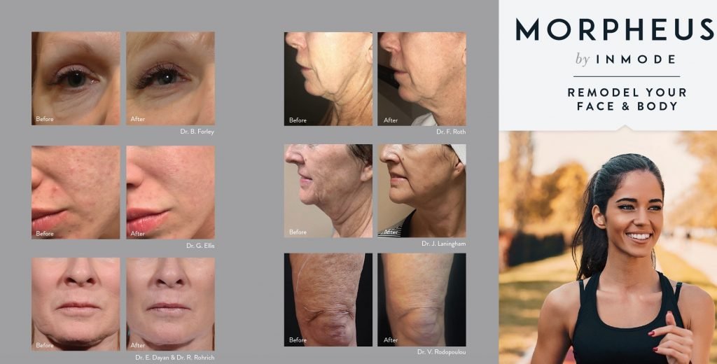 InMode Morpheus8 RF Pro Fractional RF Microneedling Machine 7 morpheus8 what to expect