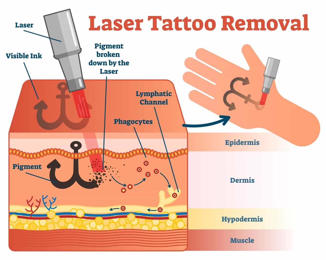 What is Laser tattoo removal